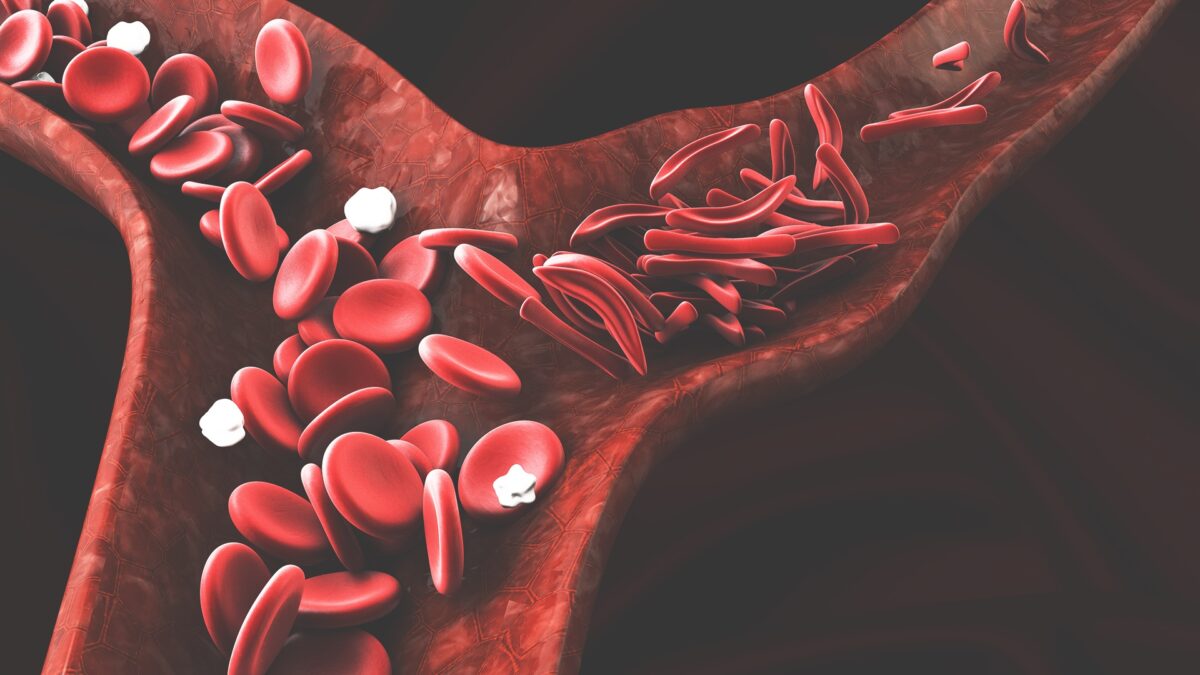 Anemia Falciforme Ou Doença Falciforme Saiba O Que é E Como Pode Ser Diagnosticada E Tratada 6502